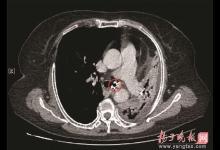 阿姨咳嗽十幾年，把左肺咳“沒”了？ “元兇”竟是顆假牙