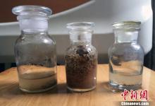 男子20年體外碎石200余次 結(jié)石仍長(zhǎng)滿腎臟