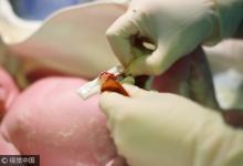 北京：臍帶血成功救治952人