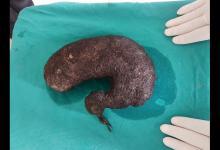 印16歲暴瘦女孩患食毛癥 醫(yī)生從胃部取出2公斤頭發(fā)