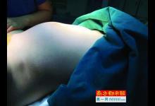 驚呆！少女腹部隆起 竟藏6斤腫瘤