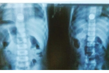 熊孩子想嘗嘗錢的味道 3歲男童吞硬幣卡喉