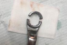 男子下體被扳手套住17小時 最后口腔科醫生解了圍