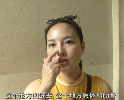 杭州美萊美容醫院把我鼻子做壞了 高價隆鼻后凹凸不平