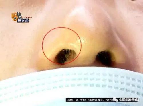 三女子整容均出現不同程度歪斜 義烏陽光美容醫院：本身就有問題