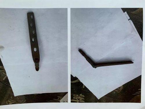 商丘市第一人民醫院79歲老人手術后死亡追蹤：用藥記錄“消失” 骨灰中手術部件有異