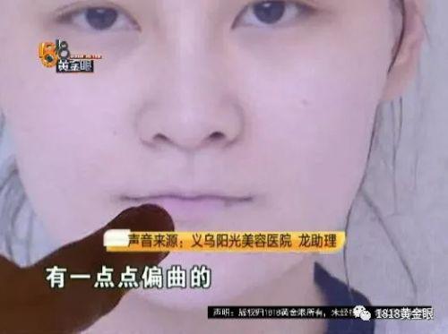 三女子整容均出現不同程度歪斜 義烏陽光美容醫院：本身就有問題