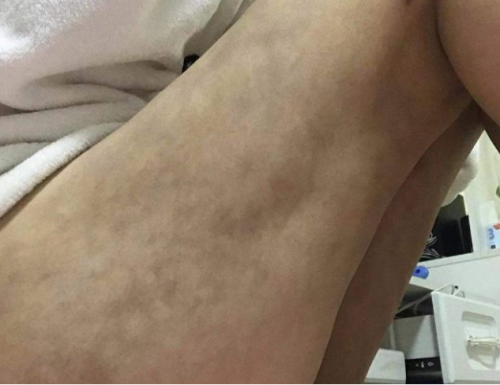 南昌亞太醫(yī)療美容醫(yī)院抽脂手術(shù)后情況很糟糕 女子維權(quán)卻被罵出來