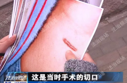 鄭州新生醫(yī)院隆鼻失敗 假體往外透院方稱沒(méi)法解決