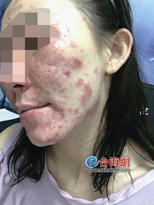漳州翌芙萊美容店涉嫌無證經營 打“水光針”致女子臉部潰爛變形