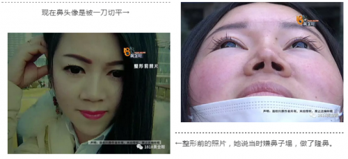 動了三次刀 患者：湖州曙光醫(yī)療美容醫(yī)院把我鼻子做的跟豬一樣