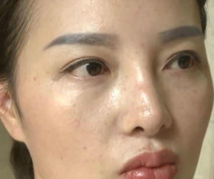 杭州美萊美容醫院把我鼻子做壞了 高價隆鼻后凹凸不平