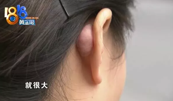杭州千晴整形醫(yī)院隆鼻后耳后根長(zhǎng)了個(gè)包 鼻孔也一大一小