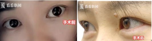 貴陽聚星妍美整形機(jī)構(gòu)又出問題了 雙眼皮整成了單眼皮？