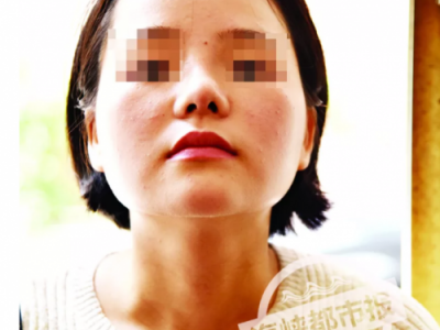 泉州東大整形醫院被投訴：女子花4.4萬整容 鼻子歪成這樣