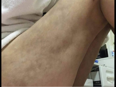 南昌亞太醫(yī)療美容醫(yī)院抽脂手術(shù)后情況很糟糕 女子維權(quán)卻被罵出來