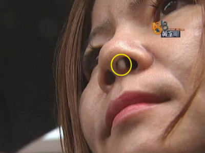 六年前在寧波珈禾整形專科醫院做隆鼻 現在鼻子不舒服露出白色假體