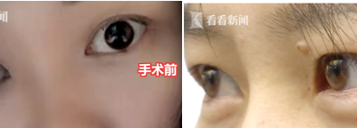 貴陽聚星妍美整形機構(gòu)又出問題了 雙眼皮整成了單眼皮？