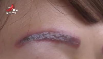 去南昌韓美美容醫(yī)院激光洗眉后生不如死 洗完感覺(jué)自己像怪物