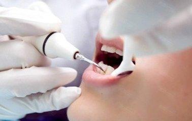 杭州美奧口腔怎么樣？洗牙能去除煙漬嗎