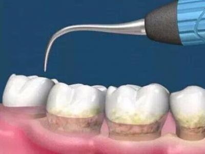 杭州美奧口腔怎么樣？洗牙能去除煙漬嗎