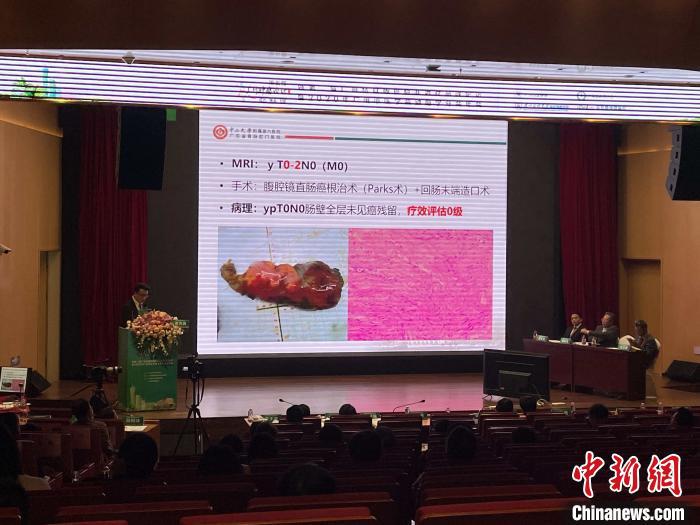 中國結直腸癌高發(fā) 專家指出不能忽略指檢