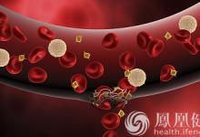 99%的血栓無(wú)征兆！記住一個(gè)字，就能遠(yuǎn)離全身血栓