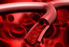 小心！血管都是被這幾個壞習慣毀掉的