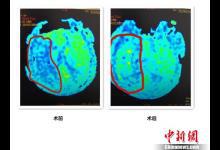 吃外賣、熬夜、少運動 小白領(lǐng)突發(fā)腦梗