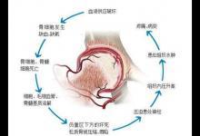 股骨頭壞死怎么緩解疼痛