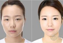 整容風(fēng)水學(xué) 不可不知的整容禁忌