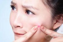 臉上長痘痘吃什么好？