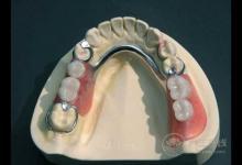 義齒有哪幾類，什么是義齒