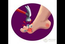 尿酸高的人注意，這3類食物碰多了，腎會(huì)“壞掉”！