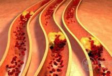 這5種食物堪稱“血管清道夫”，血管垃圾一掃空