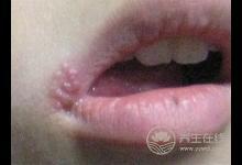 吃這些食物讓你嘴巴不上火起泡！