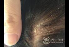 頭皮屑多很尷尬？不妨多吃這幾種食物