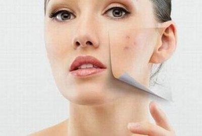 臉上長的痘痘開始發紫是什么情況