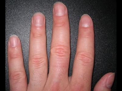 指甲有豎棱的原因以及體現出了什么