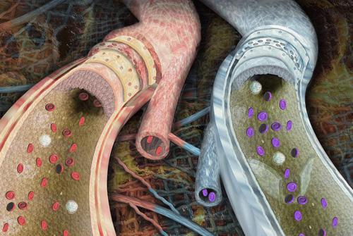 靜脈曲張患者應(yīng)該如何合理進(jìn)行運動 靜脈曲張患者應(yīng)該如何合理進(jìn)行運動