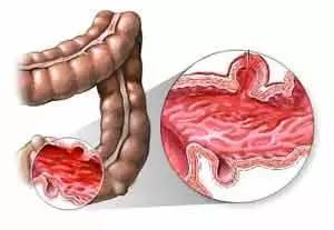 在懷孕期間出現(xiàn)腸胃炎要如何治療
