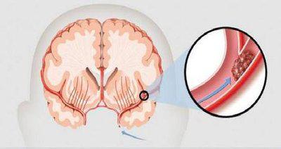 腦梗塞一旦出現(xiàn)應(yīng)該如何按摩頭部