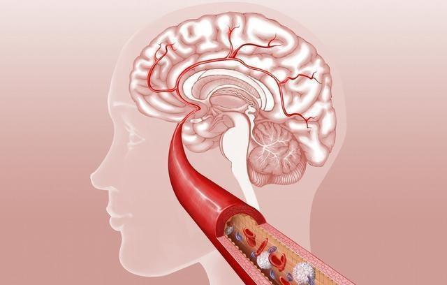 腦血栓患者吃哪些種類藥治療效果好