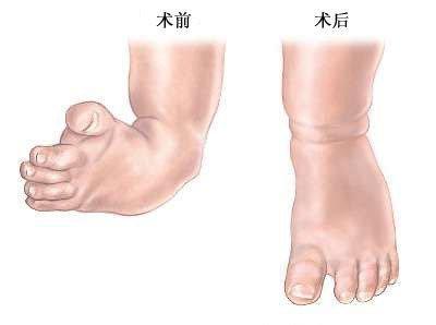 導(dǎo)致孩子足內(nèi)翻的因素以及改善方法