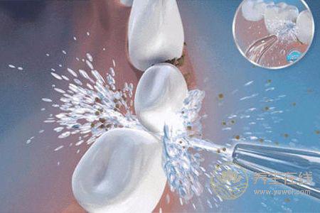 洗牙有什么好處?洗牙后注意事項有哪些?