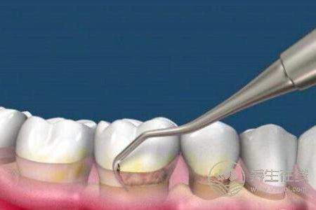 洗牙有什么好處?洗牙后注意事項有哪些?