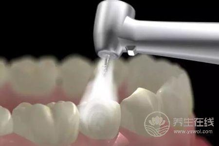 洗牙有什么好處?洗牙后注意事項有哪些?