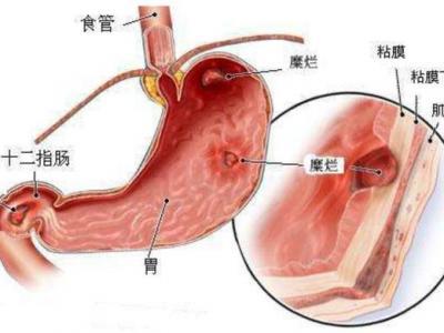 消化性潰瘍分為哪些不同的類型會(huì)有哪些表現(xiàn)