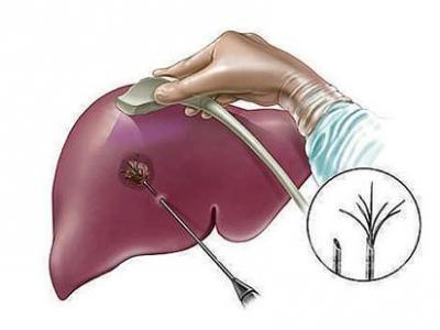肝臟功能檢查的結(jié)果正確的解讀方法