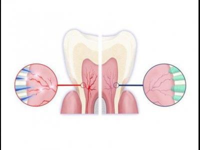 做好這六件事可以很好的預(yù)防牙齒敏感
